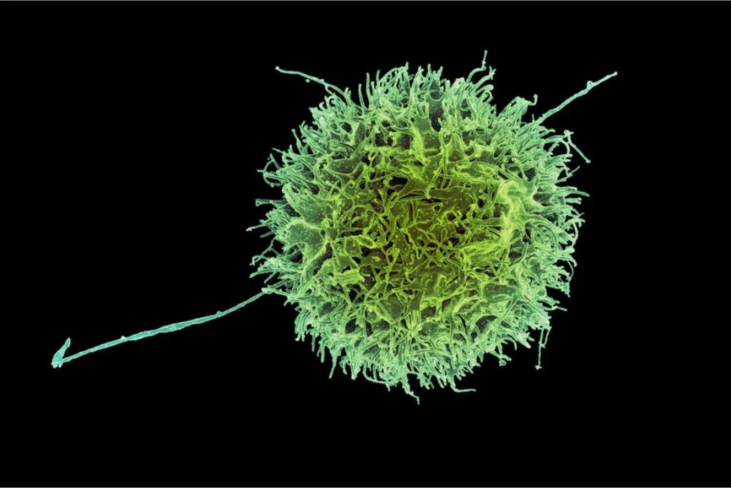 Celule ucigase naturale modificate genetic cancer